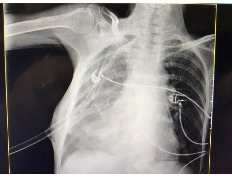 MANEJO DO DERRAME PLEURAL NO DEPARTAMENTO DE EMERGÊNCIA(DE)