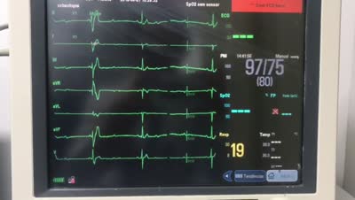 MANEJO DA TAQUICARDIA SUPRAVENTRICULAR REFRATÁRIA