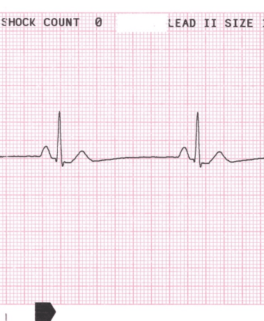 Figura-5-Bradicardia-auricular