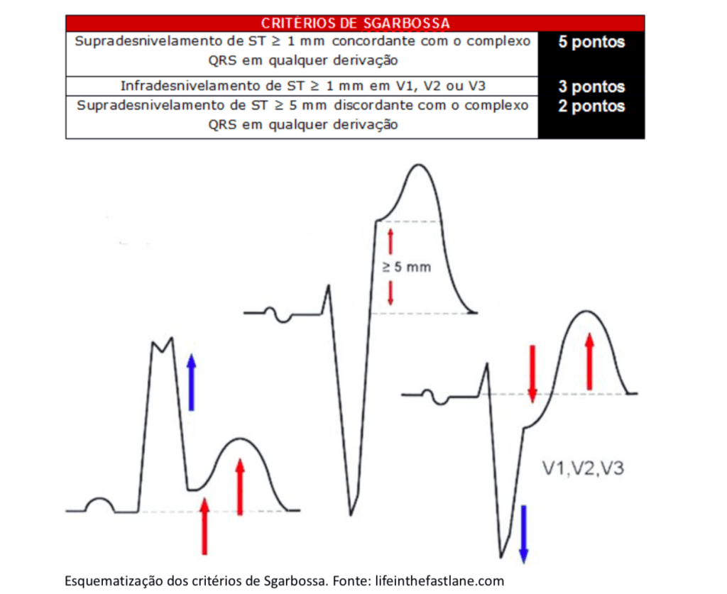 BLOQUEIO DE RAMO ESQUERDO – QUE NÃO É SABIDAMENTE NOVO – COMO AVALIAR DIANTE DA SUSPEITA DE IAM