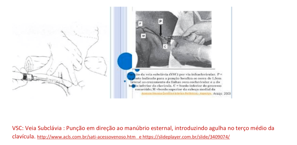 Acesso Venoso Central