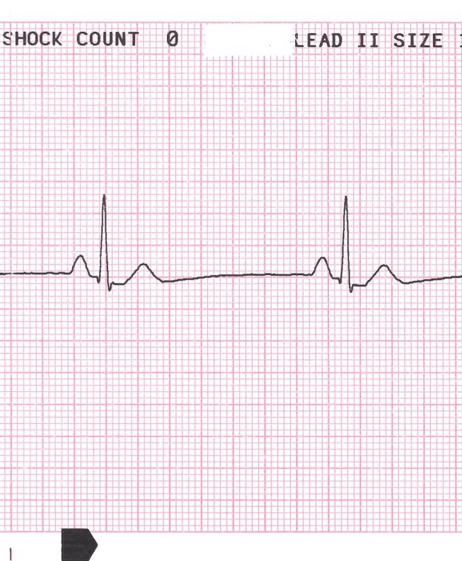 Nova Diretriz de Bradicardia da&nbsp;AHA